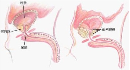前列腺癌手术治疗