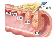 肝部瘤的主要症状