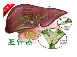 胆管癌的治疗方法有哪些 胆管癌治疗 北京伟达中医肿瘤医院官方