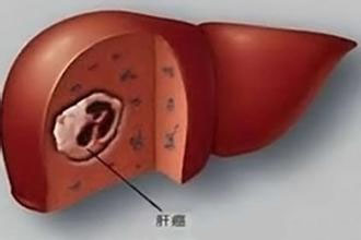 肝癌治疗的方法有哪些